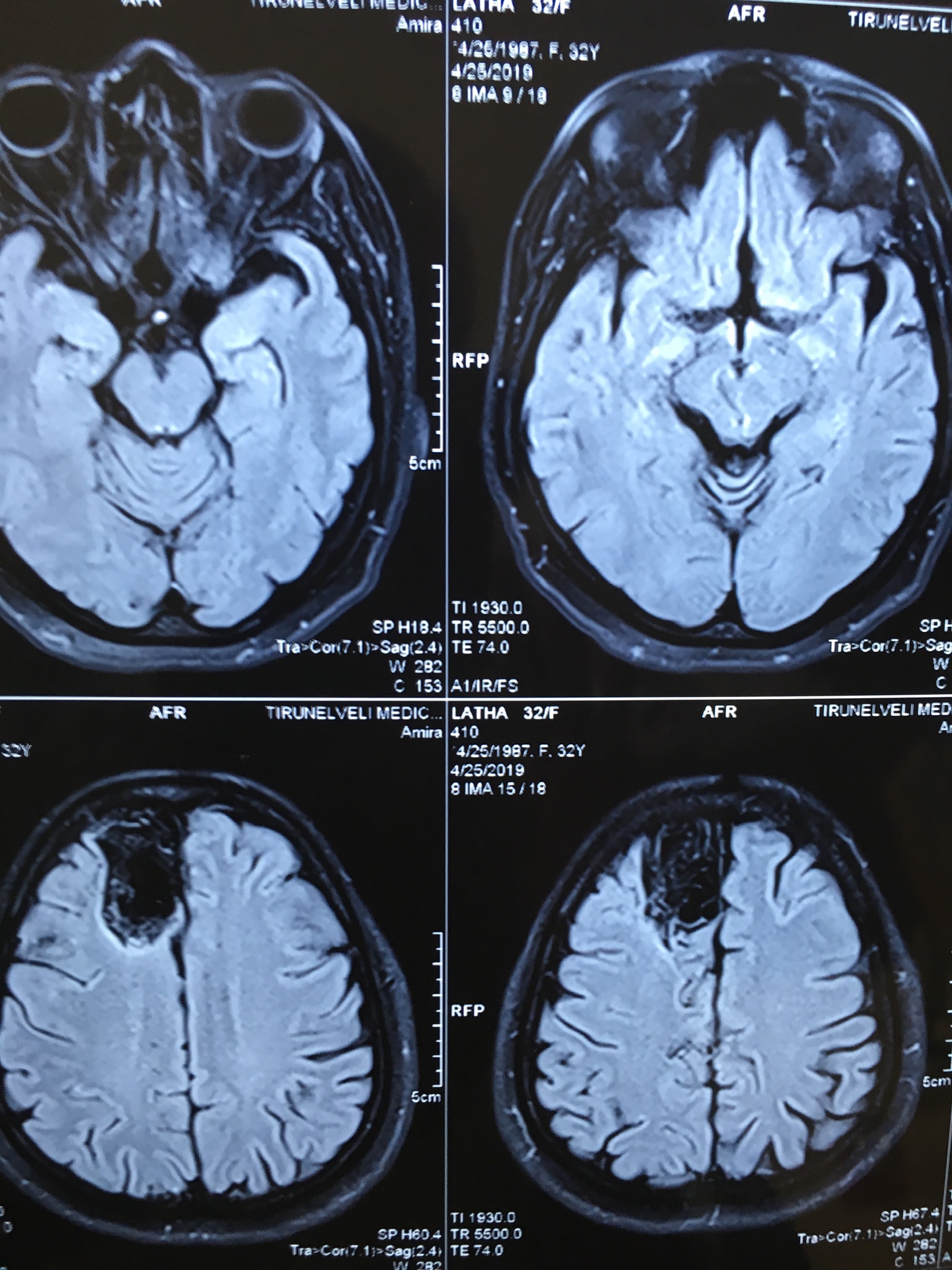 Epilepsy With Memory Changes In A Young Lady